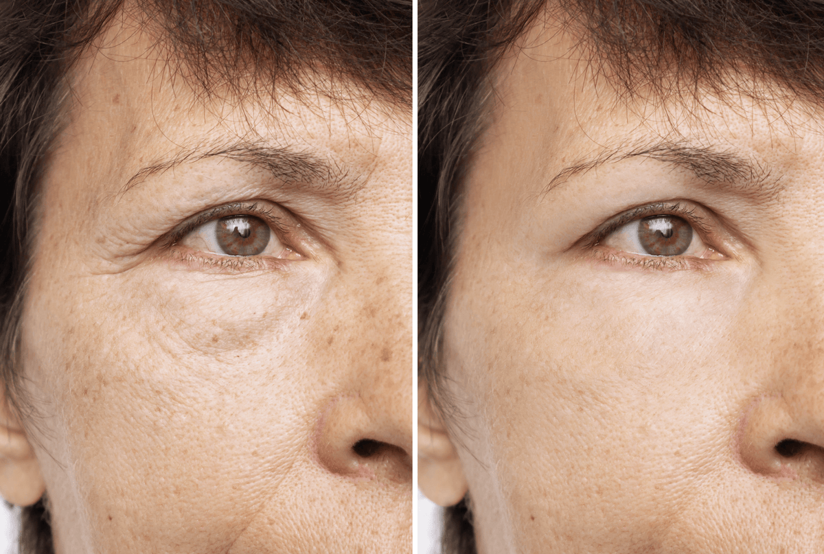 Blepharoplastik: Ein umfassender Leitfaden zur Lidchirurgie