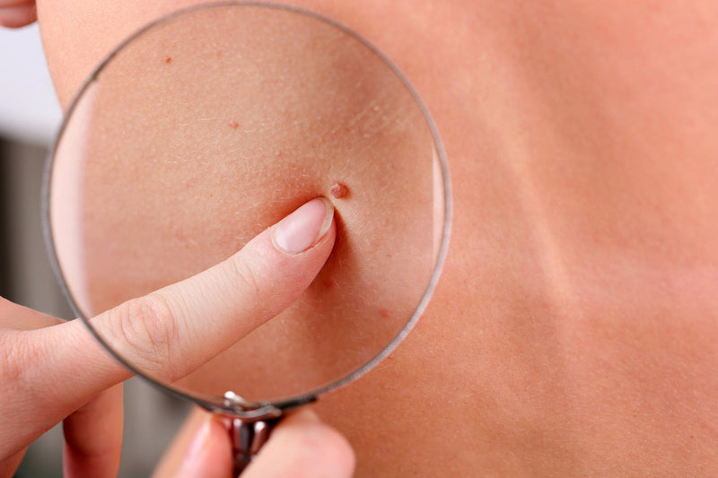 Plastische Chirurgie – Hilfe bei der Hautkrebsentfernung