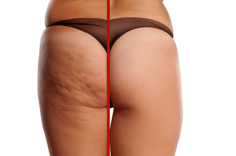 Anti-Cellulite Anwendungen mit komplexer Homöopathie